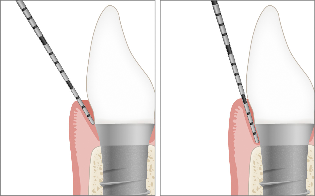 Tiefes Implantat sondieren
