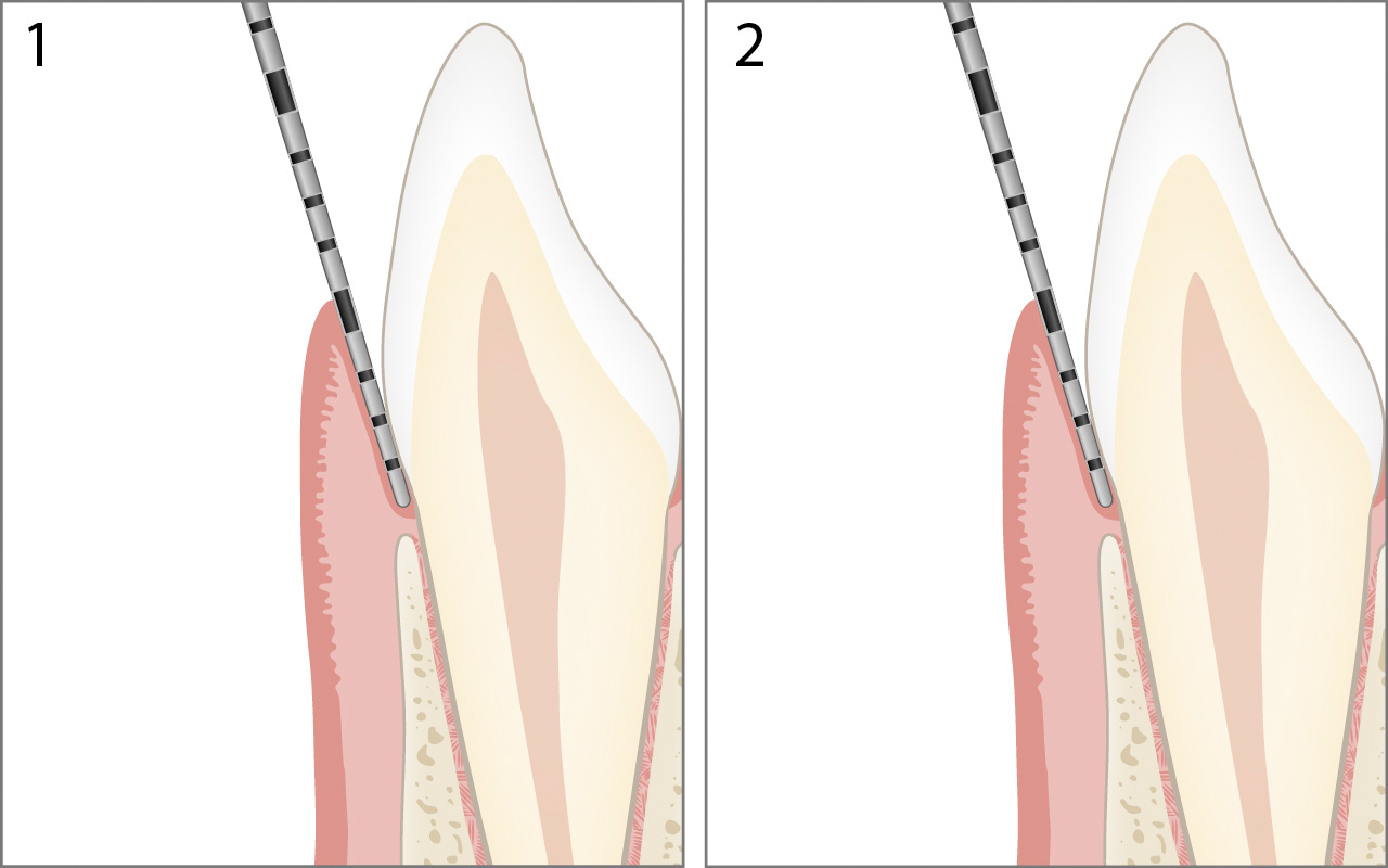 Gingivale Wucherung sondieren