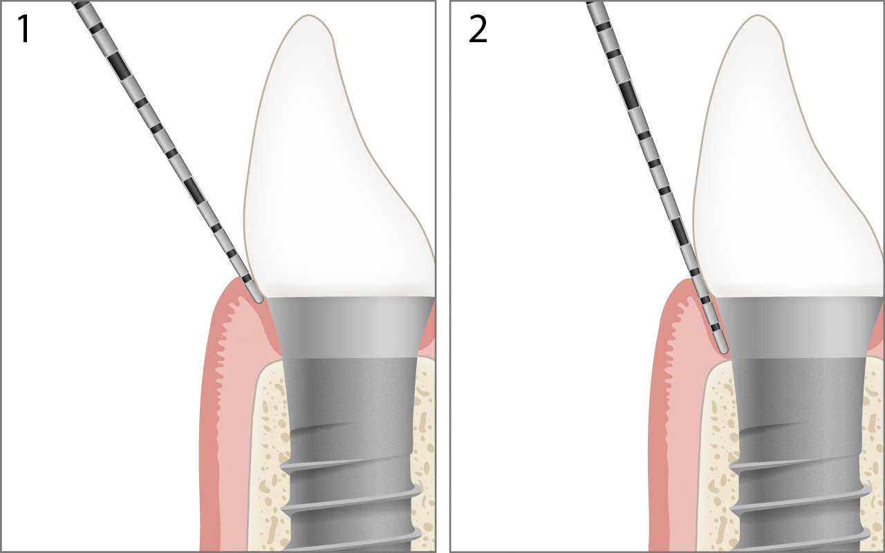Gesundes Implantat sondieren