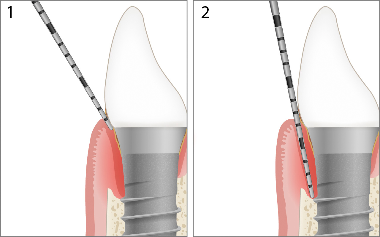Periimplantitis sondieren