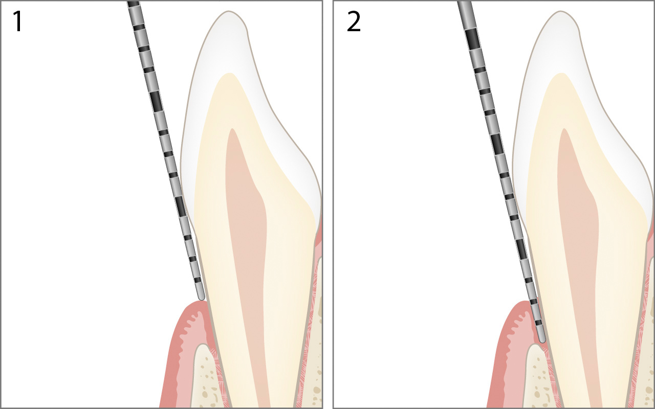 Gingivale Rezession sondieren