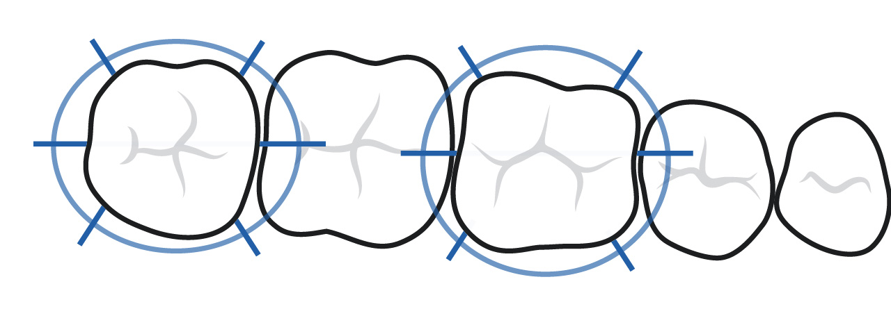 Parodontalen Sondierung sechs Stellen pro Zahn