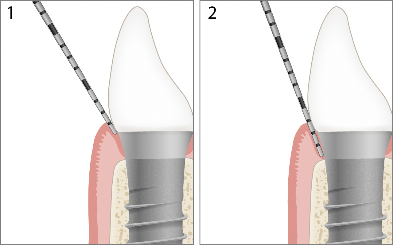 Probing healthy implant